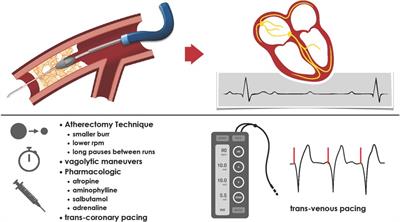 Emergency transvenous temporary pacing during rotational atherectomy